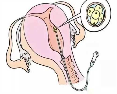 天津试管助孕：残角子宫手术哪个三甲医院好？天津医院技术详解